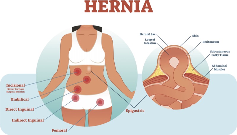Exercises to Avoid After Hernia Surgery